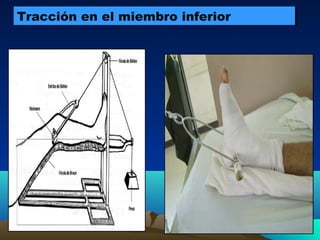 Tracción en el miembro inferiorTracción en el miembro inferior
 