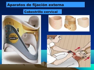 Aparatos de fijación externaAparatos de fijación externa
Cabestrillo cervicalCabestrillo cervical
 