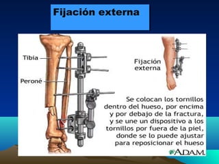 Fijación externaFijación externa
 