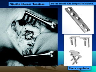 Fijación interna: TécnicasFijación interna: Técnicas
Placa anguladaPlaca angulada
Placas anchas auto compresión; Trauma,Placas anchas auto compresión; Trauma,
 