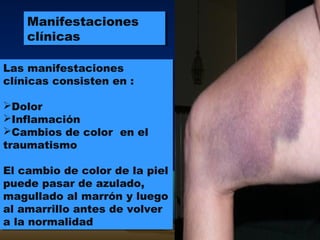 Manifestaciones
clínicas
Manifestaciones
clínicas
Las manifestaciones
clínicas consisten en :
Dolor
Inflamación
Cambios de color en el
traumatismo
El cambio de color de la piel
puede pasar de azulado,
magullado al marrón y luego
al amarrillo antes de volver
a la normalidad
Las manifestaciones
clínicas consisten en :
Dolor
Inflamación
Cambios de color en el
traumatismo
El cambio de color de la piel
puede pasar de azulado,
magullado al marrón y luego
al amarrillo antes de volver
a la normalidad
 