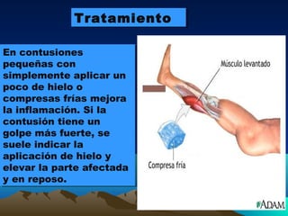 TratamientoTratamiento
En contusiones
pequeñas con
simplemente aplicar un
poco de hielo o
compresas frías mejora
la inflamación. Si la
contusión tiene un
golpe más fuerte, se
suele indicar la
aplicación de hielo y
elevar la parte afectada
y en reposo.
En contusiones
pequeñas con
simplemente aplicar un
poco de hielo o
compresas frías mejora
la inflamación. Si la
contusión tiene un
golpe más fuerte, se
suele indicar la
aplicación de hielo y
elevar la parte afectada
y en reposo.
 