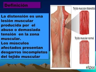 La distensión es una
lesión muscular
producida por el
abuso o demasiada
tensión en la zona
muscular.
Los músculos
afectados presentan
desgarros incompletos
del tejido muscular
La distensión es una
lesión muscular
producida por el
abuso o demasiada
tensión en la zona
muscular.
Los músculos
afectados presentan
desgarros incompletos
del tejido muscular
DefiniciónDefinición
 