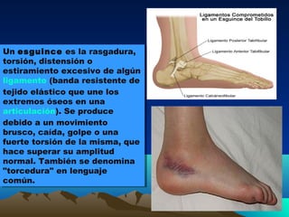 Un esguince es la rasgadura,
torsión, distensión o
estiramiento excesivo de algún
ligamento (banda resistente de
tejido elástico que une los
extremos óseos en una
articulación). Se produce
debido a un movimiento
brusco, caída, golpe o una
fuerte torsión de la misma, que
hace superar su amplitud
normal. También se denomina
"torcedura" en lenguaje
común.
Un esguince es la rasgadura,
torsión, distensión o
estiramiento excesivo de algún
ligamento (banda resistente de
tejido elástico que une los
extremos óseos en una
articulación). Se produce
debido a un movimiento
brusco, caída, golpe o una
fuerte torsión de la misma, que
hace superar su amplitud
normal. También se denomina
"torcedura" en lenguaje
común.
 