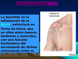 La bursitis es la
inflamación de la
Bursa, estructura en
forma de bolsa, que
se sitúa entre huesos,
tendones y músculos,
con una función
facilitadora del
movimiento de dichas
estructuras entre sí.
La bursitis es la
inflamación de la
Bursa, estructura en
forma de bolsa, que
se sitúa entre huesos,
tendones y músculos,
con una función
facilitadora del
movimiento de dichas
estructuras entre sí.
Bursitis y epicondilitis
 