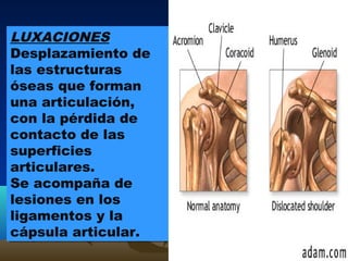 LUXACIONES
Desplazamiento de
las estructuras
óseas que forman
una articulación,
con la pérdida de
contacto de las
superficies
articulares.
Se acompaña de
lesiones en los
ligamentos y la
cápsula articular.
LUXACIONES
Desplazamiento de
las estructuras
óseas que forman
una articulación,
con la pérdida de
contacto de las
superficies
articulares.
Se acompaña de
lesiones en los
ligamentos y la
cápsula articular.
 