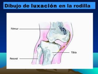 Dibujo de luxación en la rodillaDibujo de luxación en la rodilla
 