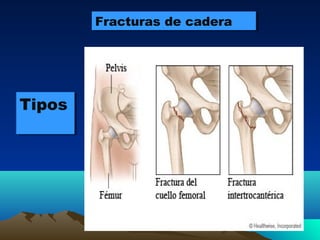Fracturas de caderaFracturas de cadera
TiposTipos
 