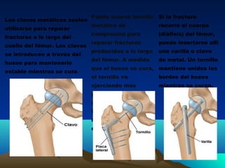 Los clavos metálicos suelen
utilizarse para reparar
fracturas a lo largo del
cuello del fémur. Los clavos
se introducen a través del
hueso para mantenerlo
estable mientras se cura.
Puede usarse tornillo
metálico de
compresión para
reparar fracturas
producidas a lo largo
del fémur. A medida
que el hueso se cura,
el tornillo va
ejerciendo más
presión; esto
mantiene unidos los
bordes del hueso
nuevo mientras se
consolidan.
Si la fractura
recorre el cuerpo
(diáfisis) del fémur,
puede insertarse allí
una varilla o clavo
de metal. Un tornillo
mantiene unidos los
bordes del hueso
mientras se curan.
 