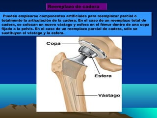 Pueden emplearse componentes artificiales para reemplazar parcial o
totalmente la articulación de la cadera. En el caso de un reemplazo total de
cadera, se colocan un nuevo vástago y esfera en el fémur dentro de una copa
fijada a la pelvis. En el caso de un reemplazo parcial de cadera, sólo se
sustituyen el vástago y la esfera.
Pueden emplearse componentes artificiales para reemplazar parcial o
totalmente la articulación de la cadera. En el caso de un reemplazo total de
cadera, se colocan un nuevo vástago y esfera en el fémur dentro de una copa
fijada a la pelvis. En el caso de un reemplazo parcial de cadera, sólo se
sustituyen el vástago y la esfera.
 