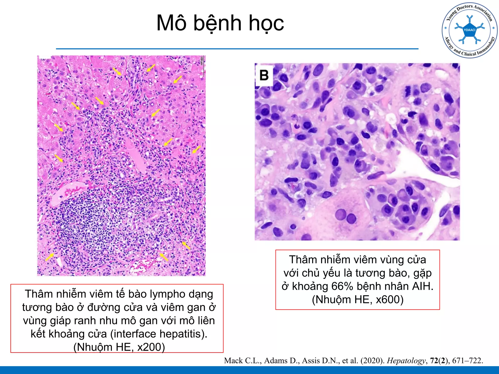 Mô bệnh học
Thâm nhiễm viêm tế bào lympho dạng
tương bào ở đường cửa và viêm gan ở
vùng giáp ranh nhu mô gan với mô liên
kết khoảng cửa (interface hepatitis).
(Nhuộm HE, x200)
Mack C.L., Adams D., Assis D.N., et al. (2020). Hepatology, 72(2), 671–722.
Thâm nhiễm viêm vùng cửa
với chủ yếu là tương bào, gặp
ở khoảng 66% bệnh nhân AIH.
(Nhuộm HE, x600)
 