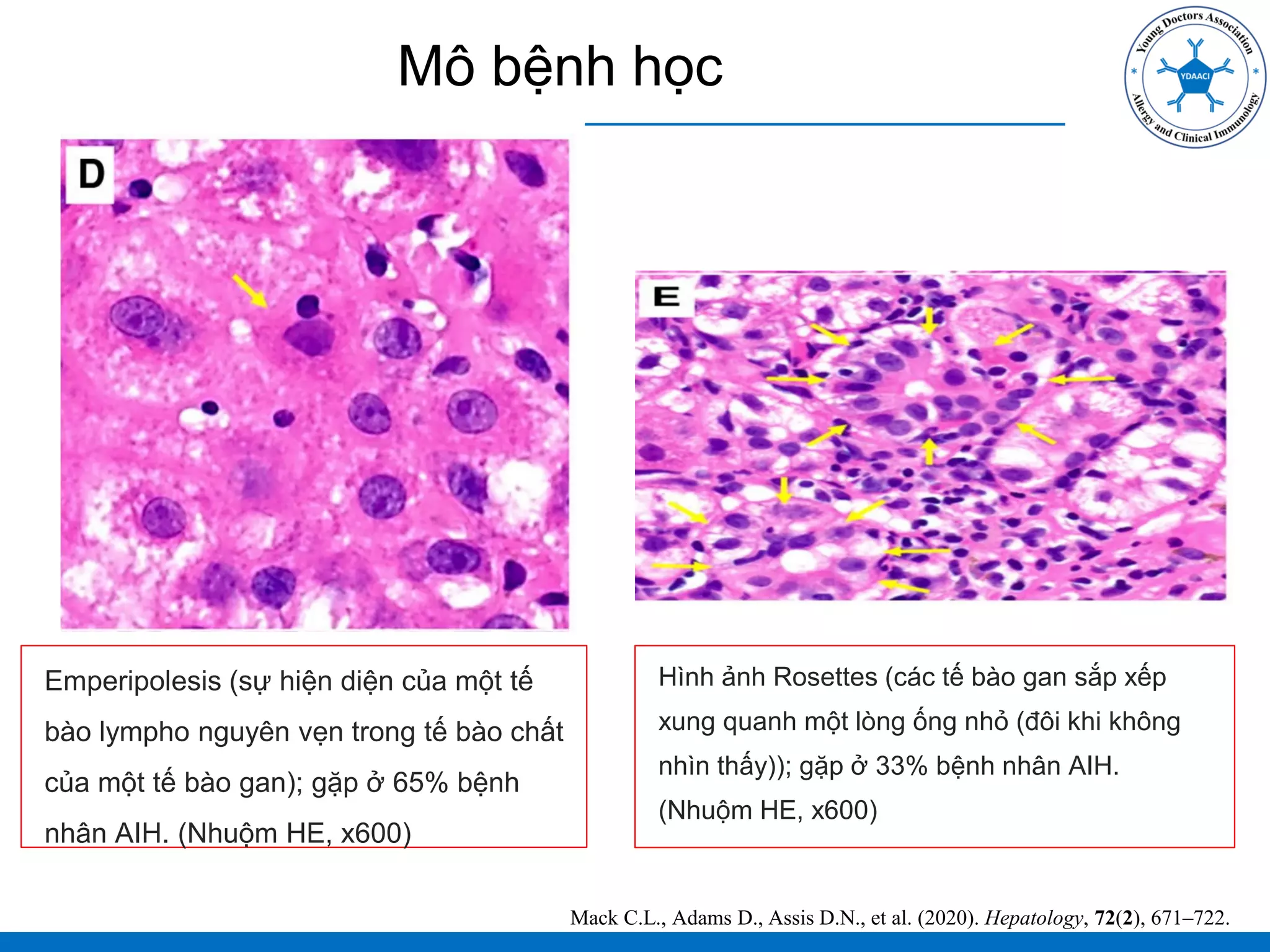 Mô bệnh học
Emperipolesis (sự hiện diện của một tế
bào lympho nguyên vẹn trong tế bào chất
của một tế bào gan); gặp ở 65% bệnh
nhân AIH. (Nhuộm HE, x600)
Mack C.L., Adams D., Assis D.N., et al. (2020). Hepatology, 72(2), 671–722.
Hình ảnh Rosettes (các tế bào gan sắp xếp
xung quanh một lòng ống nhỏ (đôi khi không
nhìn thấy)); gặp ở 33% bệnh nhân AIH.
(Nhuộm HE, x600)
 