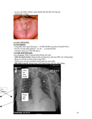 - Lơ mơ, nói nhảm, Shock: mạch nhanh nhỏ khó bắt, HA kẹp tụt.
        - Thiểu hoặc vô niệu.




        4. CẬN LÂM SÀNG:
        4.1 Xét nghiệm:
        - Công thức máu: bạch cầu tăng >= 15.000-20.000, chủ yếu là Neu(85-95%).
        - Ion đồ: rối loạn điện giải(Na+, Cl-,K+…) và dự trữ kiềm.
        - Urê/máu: tăng cao (100-300 mg%).
        4.2 Chẩn đoán hình ảnh:
        4.2.1 X-quang: chụp X-quang bụng không sửa soạn:
        - Liềm hơi dưới hoành: thủng dạ dày-tá tràng hay ruột non (80% các trường hợp).
        - Bụng mờ đều(do có dịch trong xoang PM).
        - Thành quai ruột dày lên(dịch xen kẽ giữa các quai ruột).
        - Dấu hiệu Laurell: đường sáng 2 bên thành bụng mất hay ngắt quãng.


                    Liềm
                    hơi
                    dưới
                    hoành




Cơ
hoàng
                    Bụng
                    mờ
                    đều




                                                                                          10
 