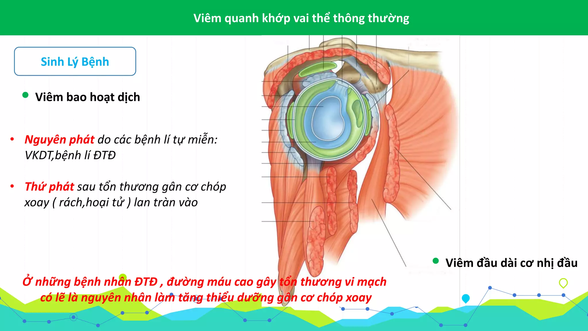 Viêm Quanh Khớp Vai - pericapsulitis shoulder.pptx