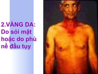 2.VÀNG DA: Do sỏi mật hoặc do phù nề đầu tụy  