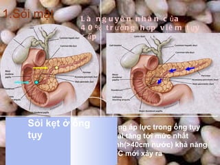 1.Sỏi mật Là nguyên nhân của 40% trường hợp viêm tụy cấp Song áp lực trong ống tụy phải tăng tới mức nhất định(>40cm nước) khả năng VTC mới xảy ra Sỏi gây tắc nghẽn ở vị trí cơ vòng Oddi Sỏi kẹt ở ống tụy 