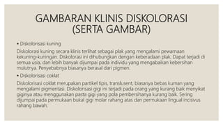 GAMBARAN KLINIS DISKOLORASI
(SERTA GAMBAR)
 Diskolorisasi kuning
Diskolorasi kuning secara klinis terlihat sebagai plak yang mengalami pewarnaan
kekuning-kuningan. Diskolorasi ini dihubungkan dengan keberadaan plak. Dapat terjadi di
semua usia, dan lebih banyak dijumpai pada individu yang mengabaikan kebersihan
mulutnya. Penyebabnya biasanya berasal dari pigmen.
 Diskolorisasi coklat
Diskolorisasi coklat merupakan partikel tipis, translusent, biasanya bebas kuman yang
mengalami pigmentasi. Diskolorisasi gigi ini terjadi pada orang yang kurang baik menyikat
giginya atau menggunakan pasta gigi yang pola pembersihanya kurang baik. Sering
dijumpai pada permukaan bukal gigi molar rahang atas dan permukaan lingual incisivus
rahang bawah.
 