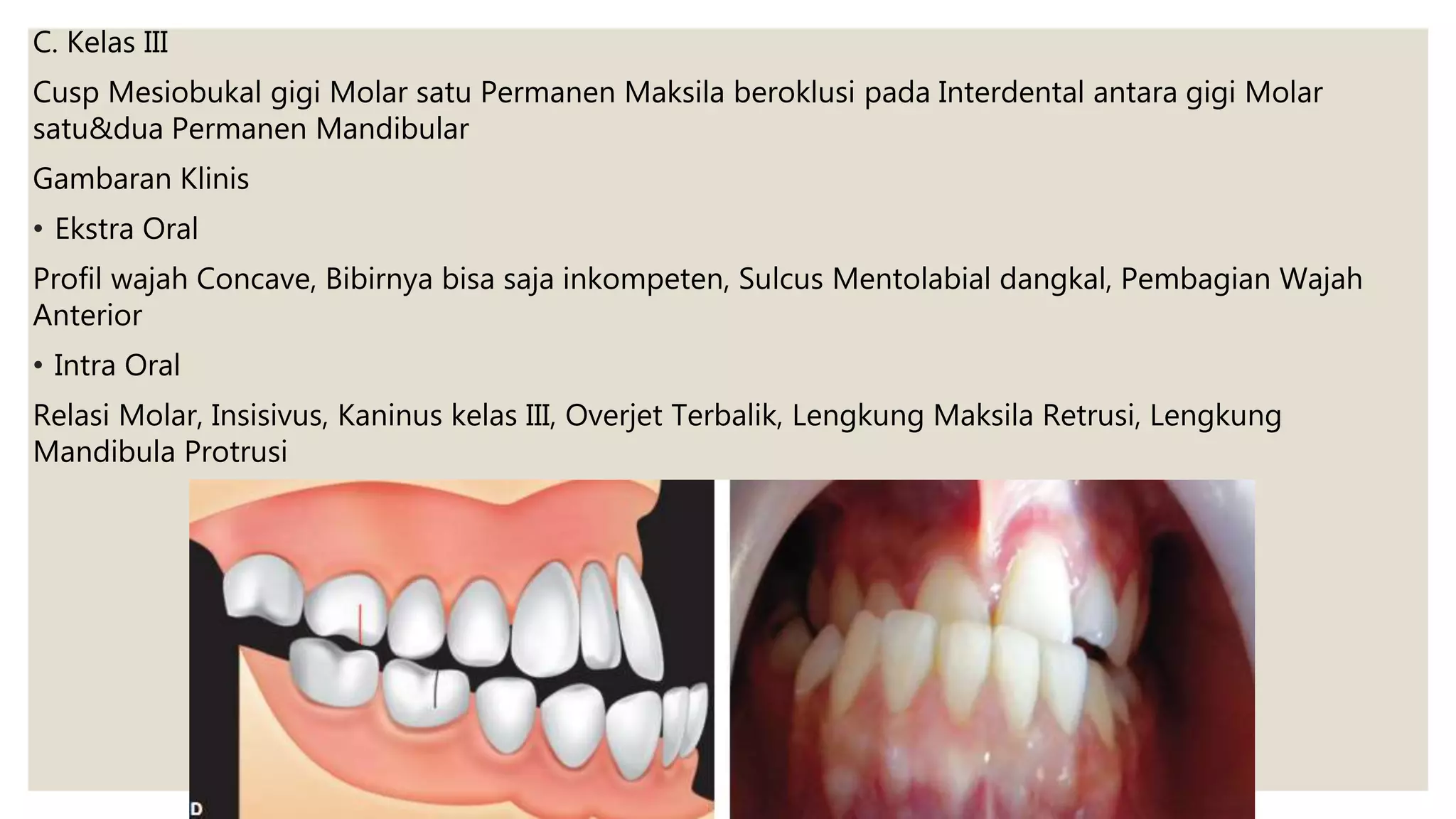 C. Kelas III
Cusp Mesiobukal gigi Molar satu Permanen Maksila beroklusi pada Interdental antara gigi Molar
satu&dua Permanen Mandibular
Gambaran Klinis
• Ekstra Oral
Profil wajah Concave, Bibirnya bisa saja inkompeten, Sulcus Mentolabial dangkal, Pembagian Wajah
Anterior
• Intra Oral
Relasi Molar, Insisivus, Kaninus kelas III, Overjet Terbalik, Lengkung Maksila Retrusi, Lengkung
Mandibula Protrusi
 