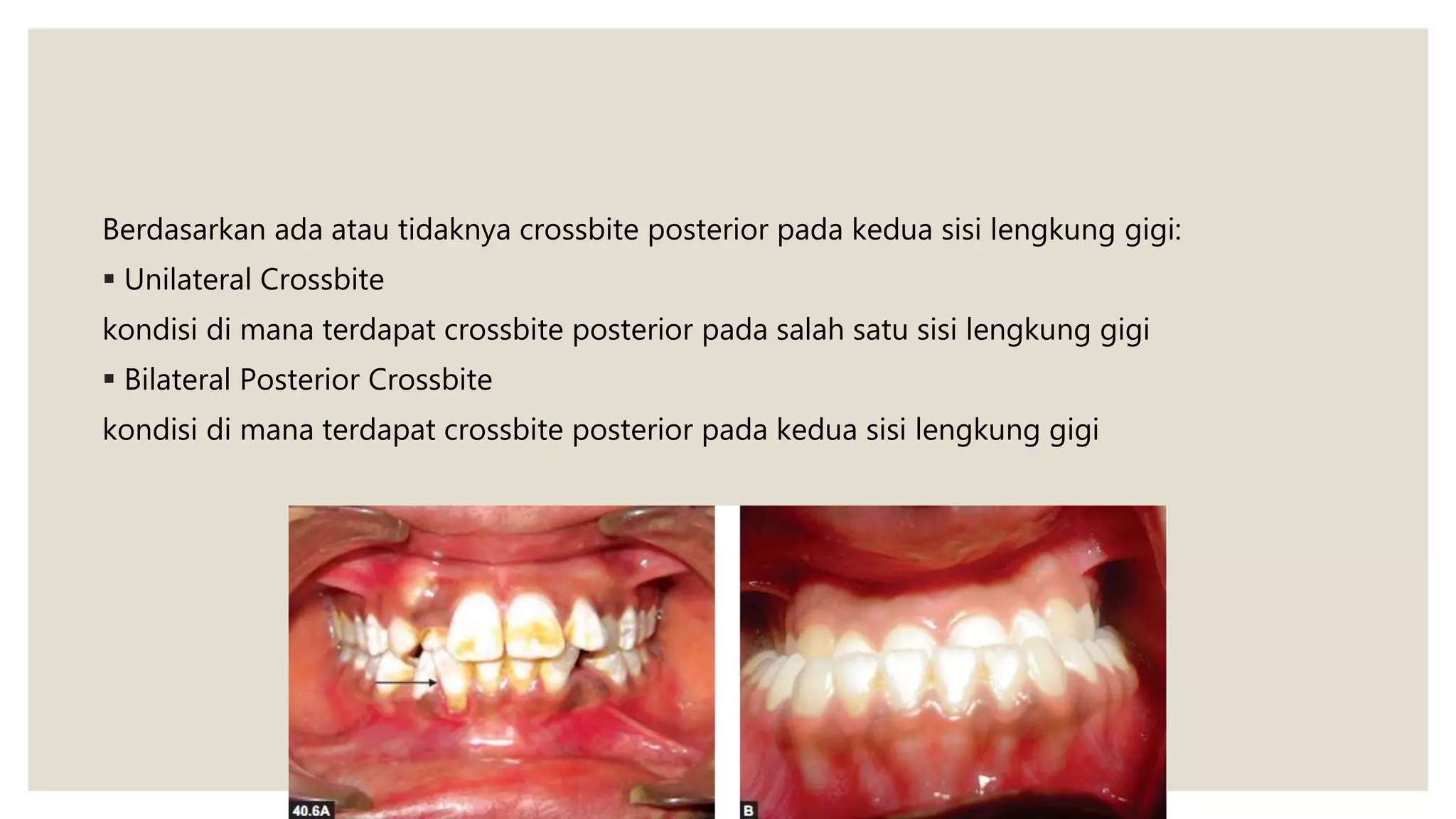 Berdasarkan ada atau tidaknya crossbite posterior pada kedua sisi lengkung gigi:
 Unilateral Crossbite
kondisi di mana terdapat crossbite posterior pada salah satu sisi lengkung gigi
 Bilateral Posterior Crossbite
kondisi di mana terdapat crossbite posterior pada kedua sisi lengkung gigi
 