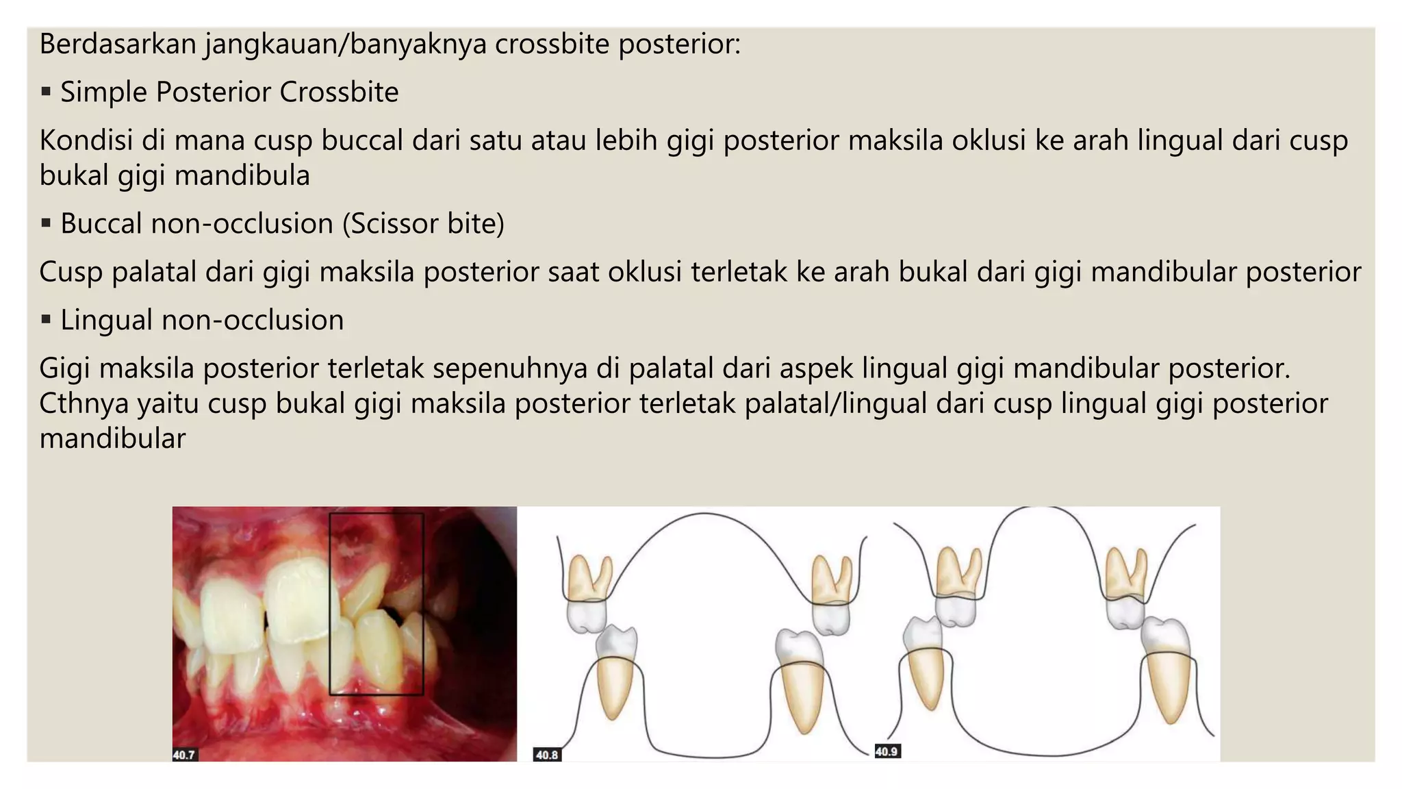 Berdasarkan jangkauan/banyaknya crossbite posterior:
 Simple Posterior Crossbite
Kondisi di mana cusp buccal dari satu atau lebih gigi posterior maksila oklusi ke arah lingual dari cusp
bukal gigi mandibula
 Buccal non-occlusion (Scissor bite)
Cusp palatal dari gigi maksila posterior saat oklusi terletak ke arah bukal dari gigi mandibular posterior
 Lingual non-occlusion
Gigi maksila posterior terletak sepenuhnya di palatal dari aspek lingual gigi mandibular posterior.
Cthnya yaitu cusp bukal gigi maksila posterior terletak palatal/lingual dari cusp lingual gigi posterior
mandibular
 
