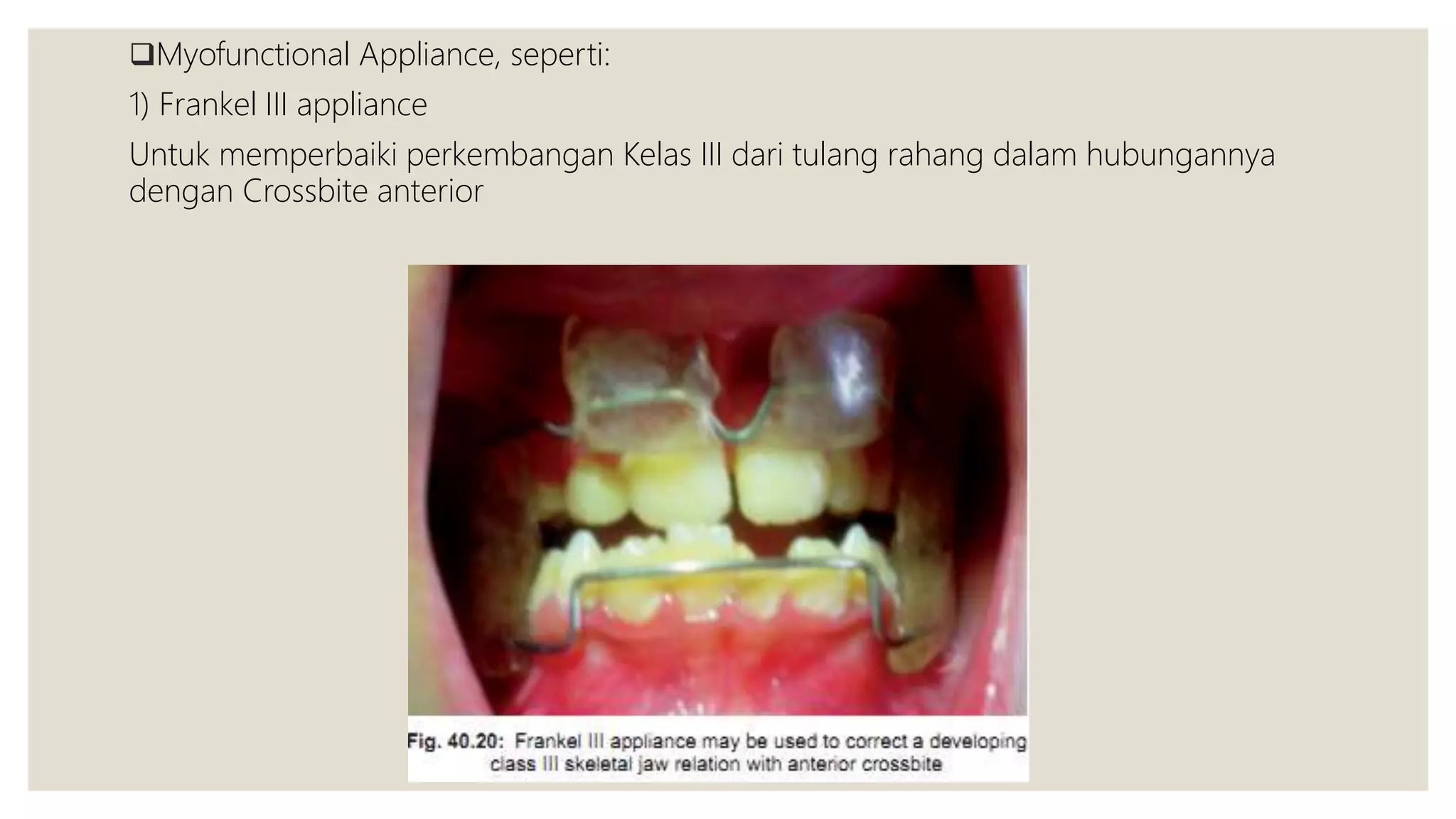 Myofunctional Appliance, seperti:
1) Frankel III appliance
Untuk memperbaiki perkembangan Kelas III dari tulang rahang dalam hubungannya
dengan Crossbite anterior
 