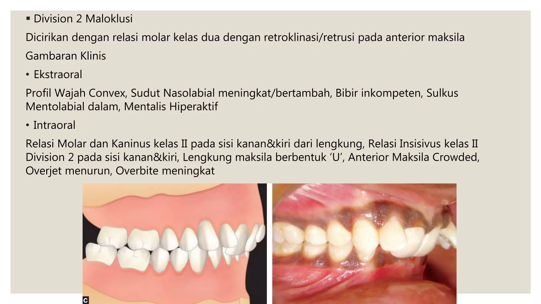  Division 2 Maloklusi
Dicirikan dengan relasi molar kelas dua dengan retroklinasi/retrusi pada anterior maksila
Gambaran Klinis
• Ekstraoral
Profil Wajah Convex, Sudut Nasolabial meningkat/bertambah, Bibir inkompeten, Sulkus
Mentolabial dalam, Mentalis Hiperaktif
• Intraoral
Relasi Molar dan Kaninus kelas II pada sisi kanan&kiri dari lengkung, Relasi Insisivus kelas II
Division 2 pada sisi kanan&kiri, Lengkung maksila berbentuk ‘U’, Anterior Maksila Crowded,
Overjet menurun, Overbite meningkat
 