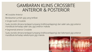 GAMBARAN KLINIS CROSSBITE
ANTERIOR & POSTERIOR
Crossbite Anterior
Berdasarkan jumlah gigi yang terlibat:
 Single tooth Crossbite
Suatu kondisi dimana terdapat tumpang tindih(overlapping) dari salah satu gigi anterior
mandibula terhadap salah satu gigi anterior maksila
 Segmental anterior Crossbite
Suatu kondisi dimana terdapat tumpang tindih(overlapping) dari kelompok gigi anterior
mandibula terhadap sekelompok gigi maksila
 