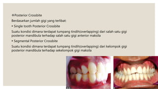 Posterior Crossbite
Berdasarkan jumlah gigi yang terlibat:
 Single tooth Posterior Crossbite
Suatu kondisi dimana terdapat tumpang tindih(overlapping) dari salah satu gigi
posterior mandibula terhadap salah satu gigi anterior maksila
 Segmental Posterior Crossbite
Suatu kondisi dimana terdapat tumpang tindih(overlapping) dari kelompok gigi
posterior mandibula terhadap sekelompok gigi maksila
 