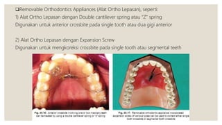 Removable Orthodontics Appliances (Alat Ortho Lepasan), seperti:
1) Alat Ortho Lepasan dengan Double cantilever spring atau “Z” spring
Digunakan untuk anterior crossbite pada single tooth atau dua gigi anterior
2) Alat Ortho Lepasan dengan Expansion Screw
Digunakan untuk mengkoreksi crossbite pada single tooth atau segmental teeth
 