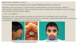 Orthopedic Appliances, seperti:
1) Face mask(Reversed Headgear) serta dengan RME(Rapid Maxillary Expansion)
Digunakan untuk perawatan crossbite anterior skeletal selama masa pertumbuhan, sebelum
pertumbuhan rahang terhenti. Alat ini membantu protrusi maksila yang mengalami retrusi, sehingga
menormalkan kembali struktur skeletal.
1) Chin cup appliance
Digunakan untuk menngarahkan kembali pertumbuhan dari mandibular untuk cegah atau
memperbaiki crossbite anterior karena pertumbuhan mandibular yang terlalu cepat. Alat ini cenderung
merotasikan mandibular ke arah posterior dan inferior.
 