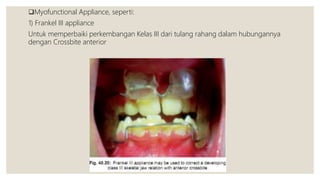 Myofunctional Appliance, seperti:
1) Frankel III appliance
Untuk memperbaiki perkembangan Kelas III dari tulang rahang dalam hubungannya
dengan Crossbite anterior
 