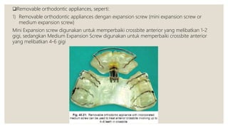 Removable orthodontic appliances, seperti:
1) Removable orthodontic appliances dengan expansion screw (mini expansion screw or
medium expansion screw)
Mini Expansion screw digunakan untuk memperbaiki crossbite anterior yang melibatkan 1-2
gigi, sedangkan Medium Expansion Screw digunakan untuk memperbaiki crossbite anterior
yang melibatkan 4-6 gigi
 