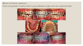 Fixed orthodontic appliances
Untuk memperbaiki crossbite anterior yang melibatkan single tooth atau segmental teeth
 