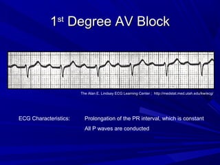 11stst
Degree AV BlockDegree AV Block
ECG Characteristics: Prolongation of the PR interval, which is constant
All P waves are conducted
The Alan E. Lindsay ECG Learning Center ; http://medstat.med.utah.edu/kw/ecg/
 