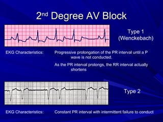 22ndnd
Degree AV BlockDegree AV Block
Type 1
(Wenckebach)
EKG Characteristics: Progressive prolongation of the PR interval until a P
wave is not conducted.
As the PR interval prolongs, the RR interval actually
shortens
EKG Characteristics: Constant PR interval with intermittent failure to conduct
Type 2
 