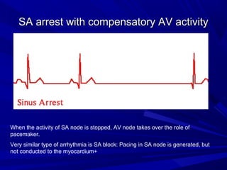 SA arrest with compensatory AV activitySA arrest with compensatory AV activity
When the activity of SA node is stopped, AV node takes over the role of
pacemaker.
Very similar type of arrhythmia is SA block: Pacing in SA node is generated, but
not conducted to the myocardium+
 