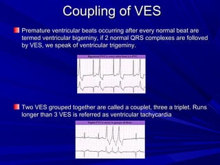 Coupling of VESCoupling of VES
Premature ventricular beats occurring after every normal beat arePremature ventricular beats occurring after every normal beat are
termed ventricular bigeminy, if 2 normal QRS complexes are follovedtermed ventricular bigeminy, if 2 normal QRS complexes are folloved
by VES, we speak of ventricular trigeminy.by VES, we speak of ventricular trigeminy.
Two VES grouped together are called a couplet, three a triplet. RunsTwo VES grouped together are called a couplet, three a triplet. Runs
longer than 3 VES is referred as ventricular tachycardialonger than 3 VES is referred as ventricular tachycardia
 