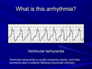 What is this arrhythmia?What is this arrhythmia?
Ventricular tachycardia
Ventricular tachycardia is usually caused by reentry, and most
commonly seen in patients following myocardial infarction.
 