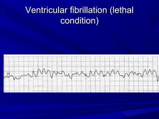 Ventricular fibrillation (lethalVentricular fibrillation (lethal
condition)condition)
 
