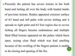  Presently the patient has severe lesions in her both
hand and itching all over the body with healed marks
of previous lesions. Rashes appeared extensor surface
of b/l hand and left palm with severe itching and it
spreads to right palm and b/l foot region due to severe
itching all fingers became oedematous and multiple
fluid filled lesions appeared on the palms which burst
open, oozing clear fluid which was foul smelling
because of the swelling of the fingers patient is unable
to do closing and opening of the fist.
7
 