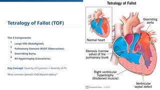 Comprehensive Overview of Congenital Heart Diseases: Epidemiology ...