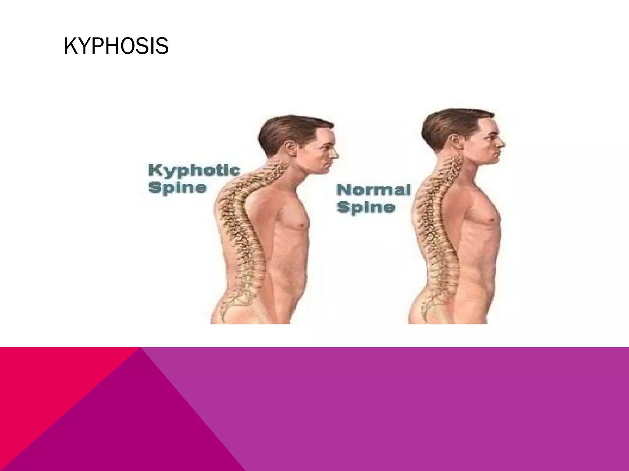 KYPHOSIS 
 
