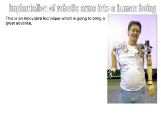 This is an innovative technique which is going to bring a great advance, implantation of robotic arms into a human being  