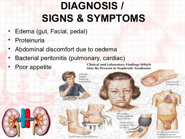 Signs And Symptoms Of Nephrotic Syndrome