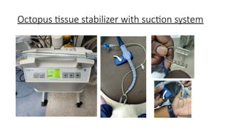 Octopus tissue stabilizer with suction system
 