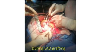 During LAD grafting
 