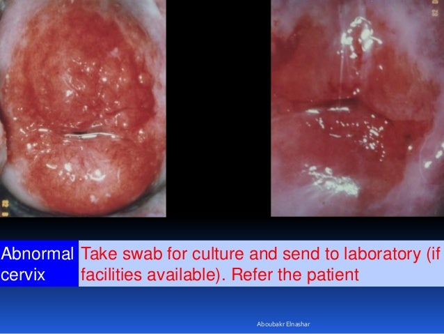 Visual inspection of cervix