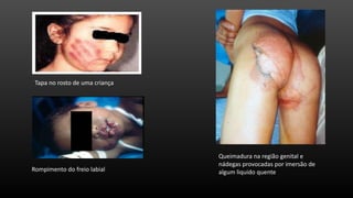 Tapa no rosto de uma criança

Rompimento do freio labial

Queimadura na região genital e
nádegas provocadas por imersão de
algum liquido quente

 