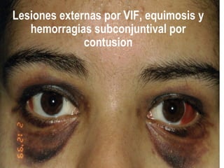 Lesiones externas por VIF, equimosis y
   hemorragias subconjuntival por
              contusion
 