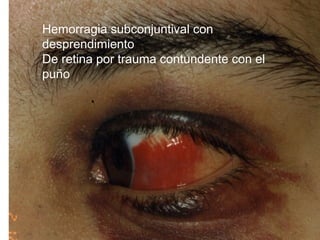 Hemorragia subconjuntival con
desprendimiento
De retina por trauma contundente con el
puño
 